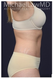 Tummy Tuck After Photo by Michael Law, MD; Raleigh, NC - Case 33603