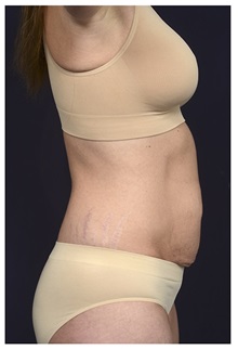 Tummy Tuck Before Photo by Michael Law, MD; Raleigh, NC - Case 33603
