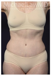 Tummy Tuck After Photo by Michael Law, MD; Raleigh, NC - Case 33604