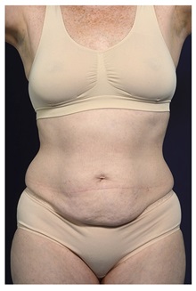 Tummy Tuck Before Photo by Michael Law, MD; Raleigh, NC - Case 33604