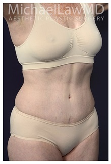 Tummy Tuck After Photo by Michael Law, MD; Raleigh, NC - Case 33604