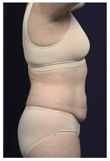 Tummy Tuck Before Photo by Michael Law, MD; Raleigh, NC - Case 33604