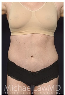 Tummy Tuck After Photo by Michael Law, MD; Raleigh, NC - Case 33605
