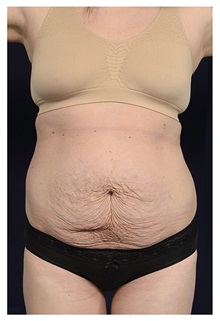 Tummy Tuck Before Photo by Michael Law, MD; Raleigh, NC - Case 33605