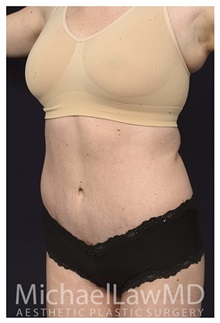 Tummy Tuck After Photo by Michael Law, MD; Raleigh, NC - Case 33605