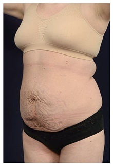 Tummy Tuck Before Photo by Michael Law, MD; Raleigh, NC - Case 33605