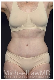 Tummy Tuck After Photo by Michael Law, MD; Raleigh, NC - Case 33606