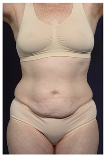 Tummy Tuck Before Photo by Michael Law, MD; Raleigh, NC - Case 33606