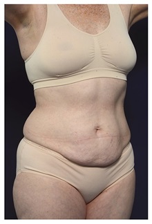 Tummy Tuck Before Photo by Michael Law, MD; Raleigh, NC - Case 33606