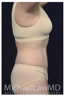 Tummy Tuck After Photo by Michael Law, MD; Raleigh, NC - Case 33606