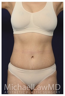 Tummy Tuck After Photo by Michael Law, MD; Raleigh, NC - Case 33607