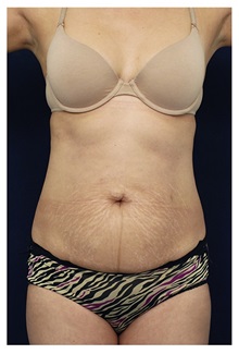Tummy Tuck Before Photo by Michael Law, MD; Raleigh, NC - Case 33607