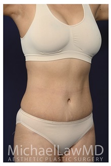 Tummy Tuck After Photo by Michael Law, MD; Raleigh, NC - Case 33607