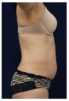 Tummy Tuck Before Photo by Michael Law, MD; Raleigh, NC - Case 33607