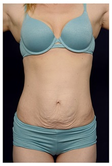 Tummy Tuck Before Photo by Michael Law, MD; Raleigh, NC - Case 33608