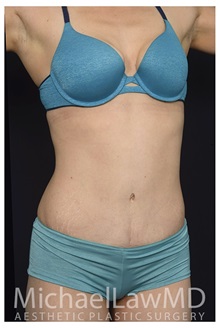 Tummy Tuck After Photo by Michael Law, MD; Raleigh, NC - Case 33608