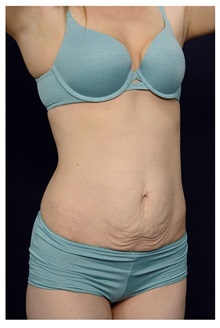 Tummy Tuck Before Photo by Michael Law, MD; Raleigh, NC - Case 33608