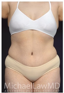 Tummy Tuck After Photo by Michael Law, MD; Raleigh, NC - Case 33609