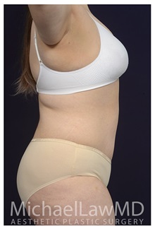 Tummy Tuck After Photo by Michael Law, MD; Raleigh, NC - Case 33609