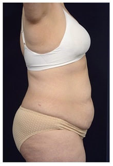 Tummy Tuck Before Photo by Michael Law, MD; Raleigh, NC - Case 33609