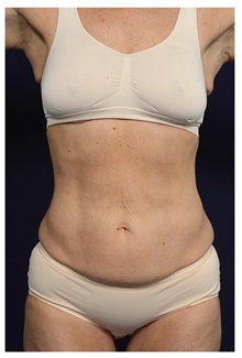 Tummy Tuck Before Photo by Michael Law, MD; Raleigh, NC - Case 33610