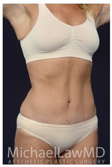 Tummy Tuck After Photo by Michael Law, MD; Raleigh, NC - Case 33610