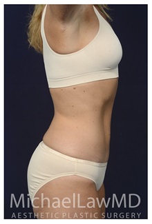 Tummy Tuck After Photo by Michael Law, MD; Raleigh, NC - Case 33610
