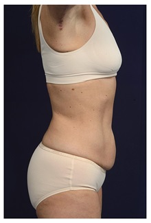Tummy Tuck Before Photo by Michael Law, MD; Raleigh, NC - Case 33610