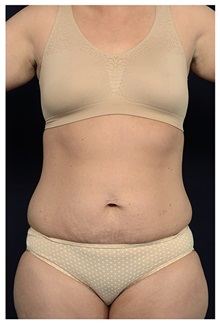 Tummy Tuck Before Photo by Michael Law, MD; Raleigh, NC - Case 33611