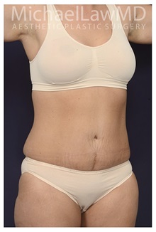 Tummy Tuck After Photo by Michael Law, MD; Raleigh, NC - Case 33611