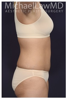 Tummy Tuck After Photo by Michael Law, MD; Raleigh, NC - Case 33611