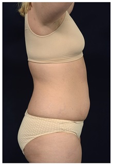 Tummy Tuck Before Photo by Michael Law, MD; Raleigh, NC - Case 33611