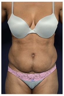 Tummy Tuck Before Photo by Michael Law, MD; Raleigh, NC - Case 33612