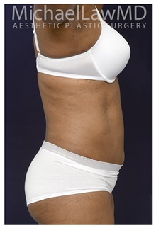 Tummy Tuck After Photo by Michael Law, MD; Raleigh, NC - Case 33612