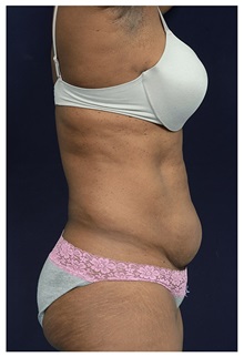 Tummy Tuck Before Photo by Michael Law, MD; Raleigh, NC - Case 33612