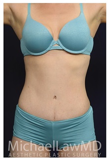 Tummy Tuck After Photo by Michael Law, MD; Raleigh, NC - Case 33613