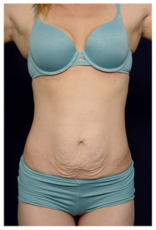 Tummy Tuck Before Photo by Michael Law, MD; Raleigh, NC - Case 33613