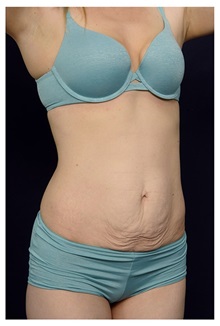Tummy Tuck Before Photo by Michael Law, MD; Raleigh, NC - Case 33613