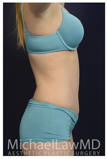 Tummy Tuck After Photo by Michael Law, MD; Raleigh, NC - Case 33613