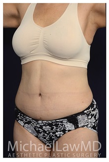 Tummy Tuck After Photo by Michael Law, MD; Raleigh, NC - Case 33614