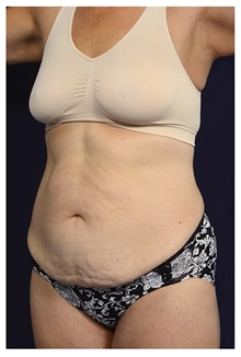Tummy Tuck Before Photo by Michael Law, MD; Raleigh, NC - Case 33614