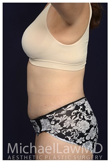 Tummy Tuck After Photo by Michael Law, MD; Raleigh, NC - Case 33614