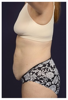 Tummy Tuck Before Photo by Michael Law, MD; Raleigh, NC - Case 33614