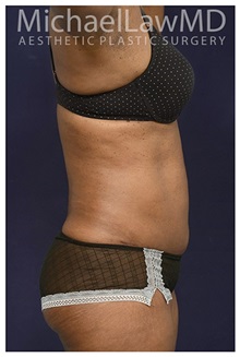 Tummy Tuck After Photo by Michael Law, MD; Raleigh, NC - Case 33615