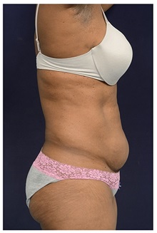Tummy Tuck Before Photo by Michael Law, MD; Raleigh, NC - Case 33615
