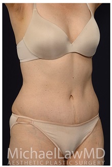 Tummy Tuck After Photo by Michael Law, MD; Raleigh, NC - Case 33616