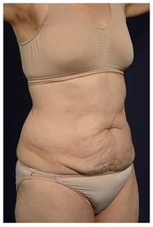 Tummy Tuck Before Photo by Michael Law, MD; Raleigh, NC - Case 33616