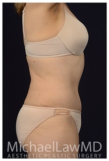 Tummy Tuck After Photo by Michael Law, MD; Raleigh, NC - Case 33616