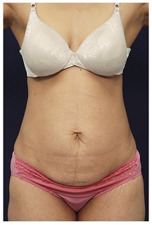 Tummy Tuck Before Photo by Michael Law, MD; Raleigh, NC - Case 33617