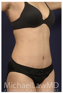 Tummy Tuck After Photo by Michael Law, MD; Raleigh, NC - Case 33617